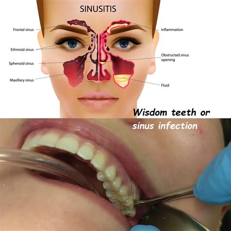 Does Sinusitis Cause Teeth Pain