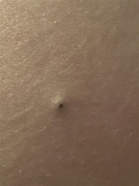 Bf popped a giant (back) blackhead : r/popping