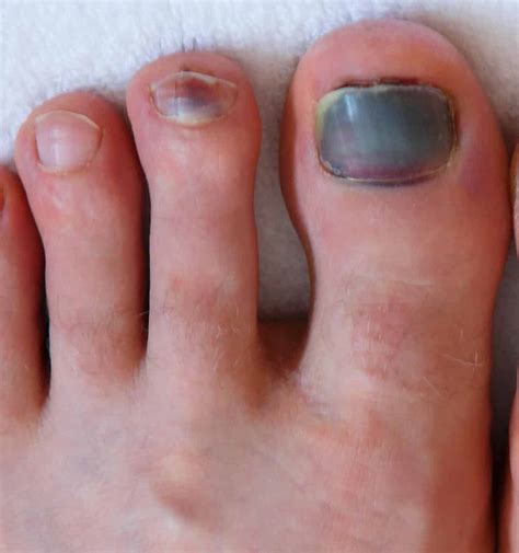Red Toenail Bed [Causes, Home Remedies & Best Treatment!]