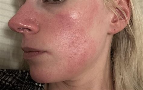 Wheres my flushed skin peeps at : r/SkincareAddicts