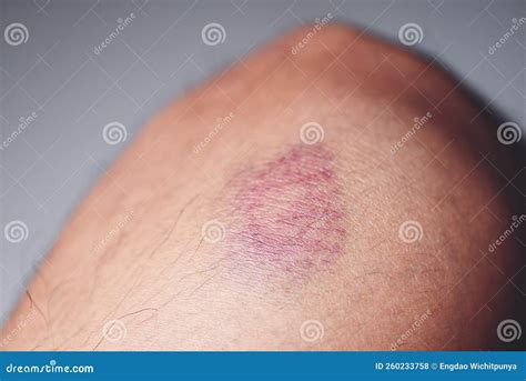 Bruised on Knee - Wound Bruised on Leg Caused by Sports and Bump or Fall, Leg Injury Stock Photo ...