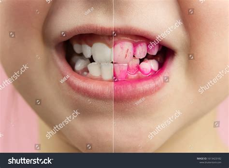 Plaque Disclosing Tablets Work Before After Stock Photo (Edit Now ...
