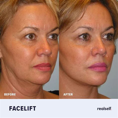 SMAS facelift | Facelift, Mid face lift, Facial plastic