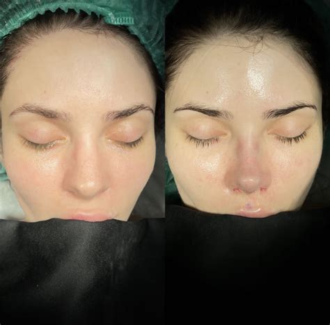 Rhinoplasty | Rhinoplasty nose jobs, Nose job, Nose plastic surgery