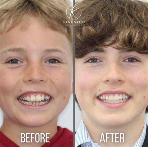 Crowded Teeth Before And After Braces