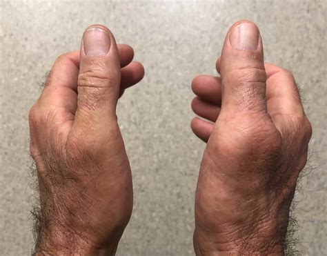 Radial Collateral Ligament Thumb