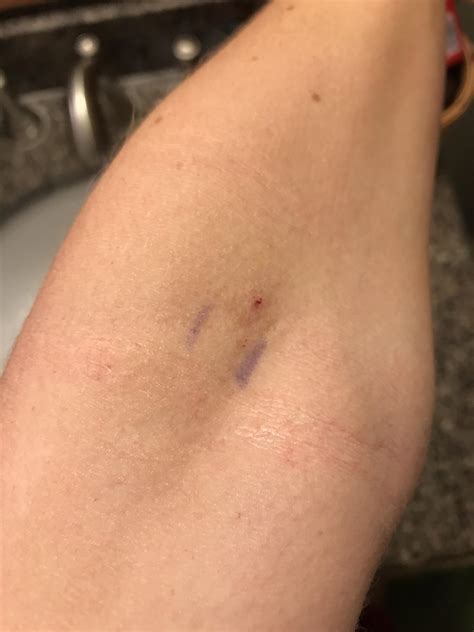Blood Donation Bruises