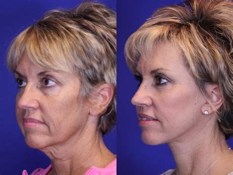 Ultra Laser Face Lift at Georgia Challis blog