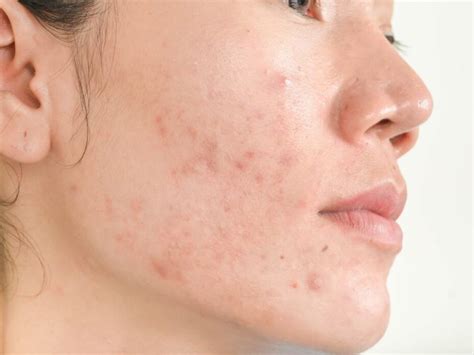 Как избавиться от подкожных прыщей-эффективные методы лечения