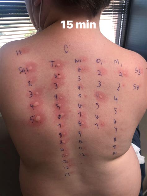 Back Allergy Skin Test at Cody Wray blog