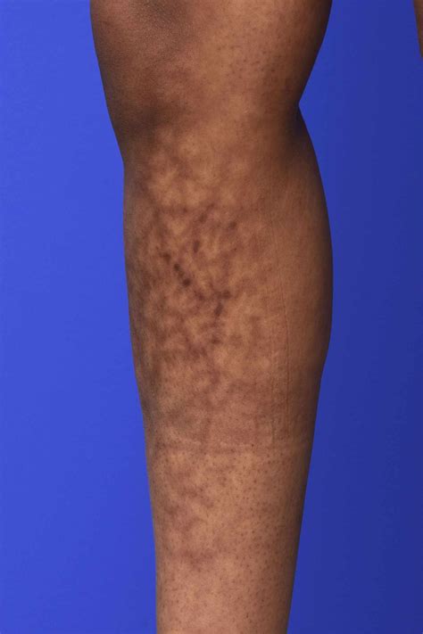 Mild Livedo Reticularis Livedo On Thighs NeuroTalk Support Groups