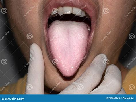 Coated Tongue or White Tongue. Loss of Taste Called Ageusia Stock Image - Image of candidiasis ...