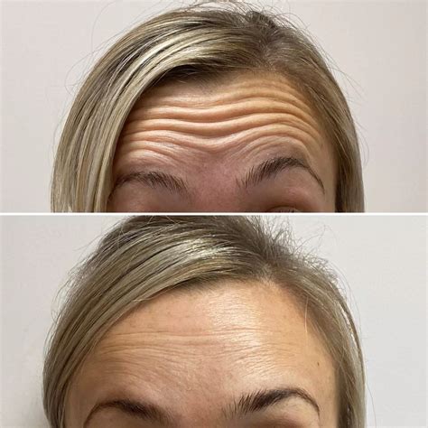 Forehead Lines - Twoth Dental + Facial Aesthetics