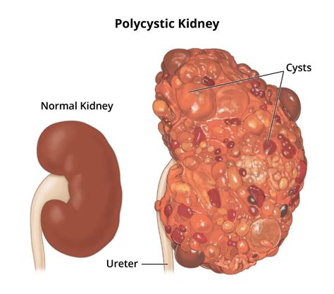 Renal Cyst Disease