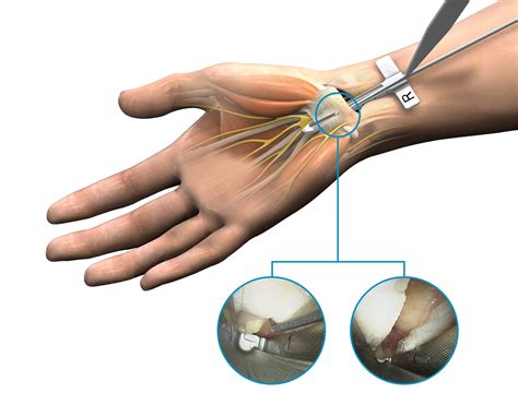 Treating carpal tunnel syndrome outside the OR shortens procedure and ...