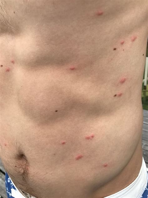 What Is Swimmers Rash at Rebecca Skinner blog