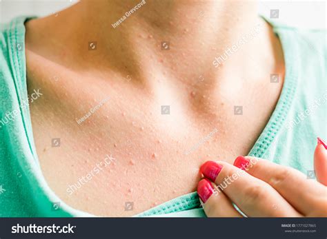 Mild Chest Acne