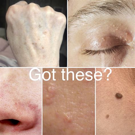 Sebaceous Hyperplasia Treatment