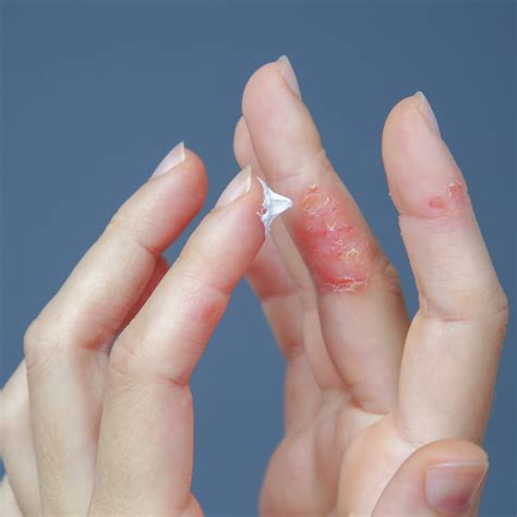 Contact Dermatitis: An Overview - Accelerated Urgent Care