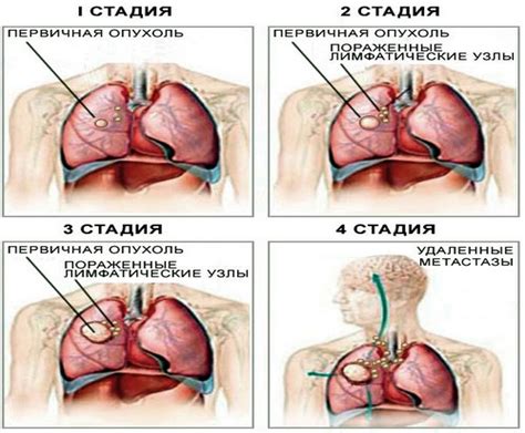 Рак легких 3 стадии: особенности, симптомы и лечение