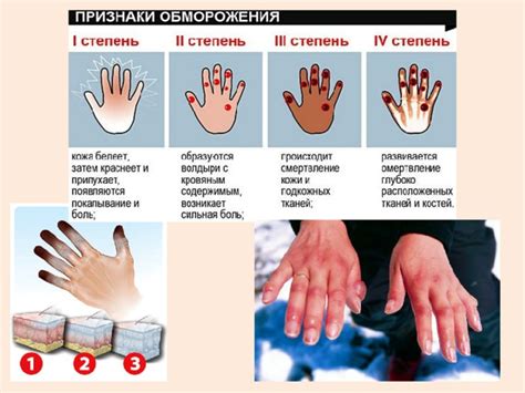 Обморожение человека: причины, признаки, первая помощь