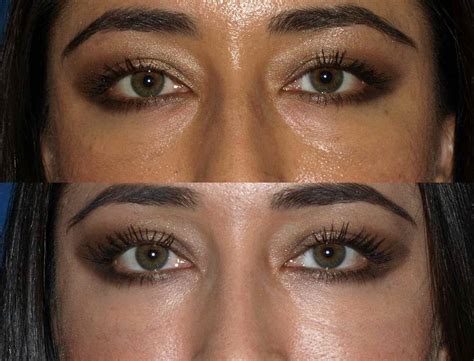 Under Eye Fillers Vs Fat Grafting at Rina Parra blog