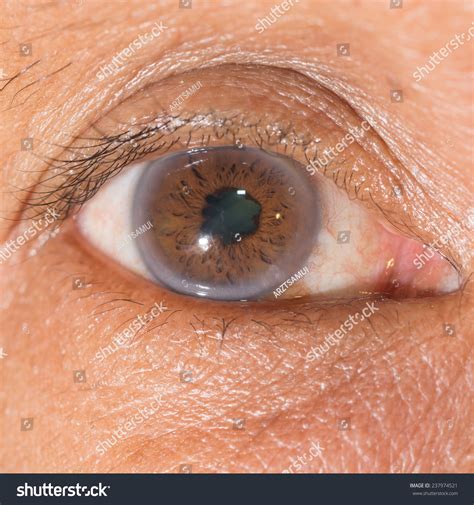 Posterior Synechiae
