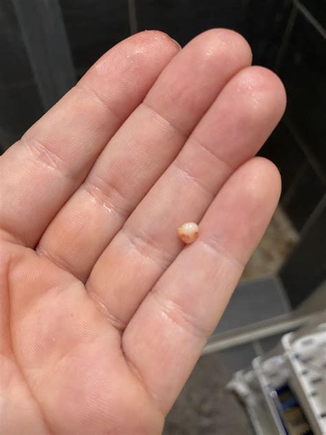 Pilar Cyst Popping out of scalp : r/popping