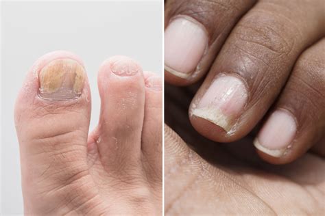 Psoriasis Nails Treatment