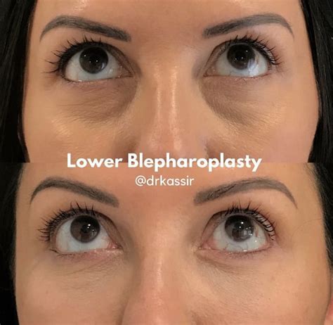 Under eye surgery online