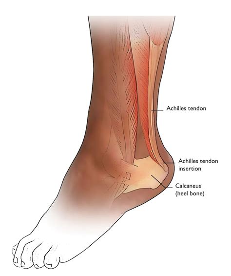 Red Achilles Tendon