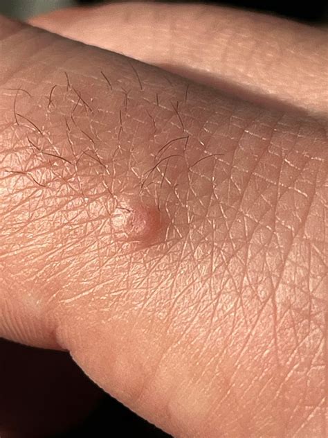 Weird bump on my finger has has gotten larger over the past few months. : r/DermatologyQuestions