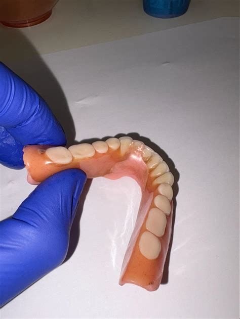 How Long Do Dentures Last? | Schaefer Denture Clinic