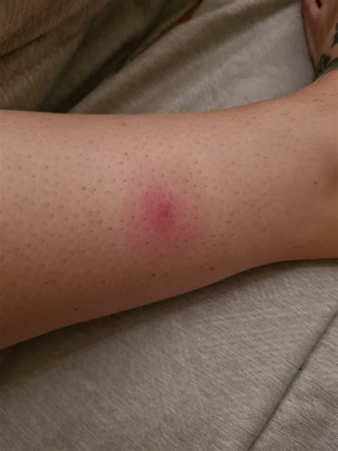 Brown Widow Bite : r/spiderbites