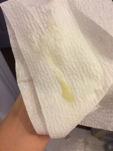 Yellow Discharge With Odor Belly Button at Benjamin Rebecca blog