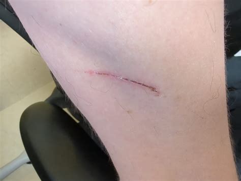 Itchy Scab