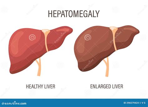 Hepatomegaly, Liver Diseases. Healthy Liver and Enlarged Liver. Medical ...