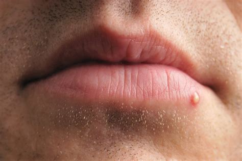 White Spots on Lips Causes, Pictures, Small, on Lower, Upper, Inside Lip - American Celiac