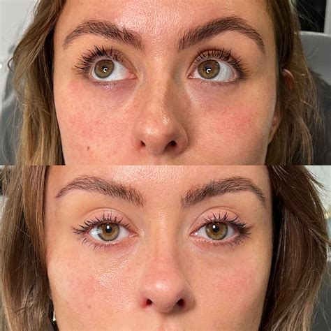 Polynucleotide Treatment | Salmon Sperm Facial | Faces By Bae