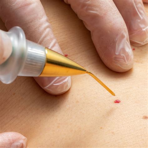 Cherry Angioma Removal | Red Moles on Skin | Red Cherry Spot Laser