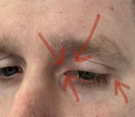 The skin around my eyes is itchy all the time, particularly in the corner of my right eye and ...