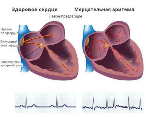 Наджелудочковая экстрасистолия: причины, симптомы и лечение в статье ...