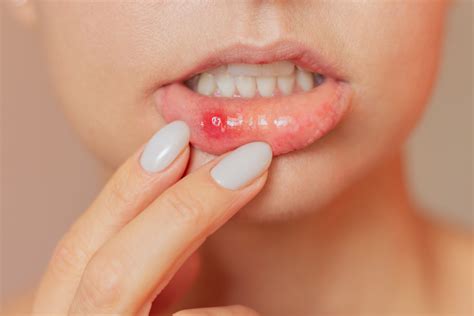 What are the Common Causes of Mouth Ulcers? - Kenalog in Orabase