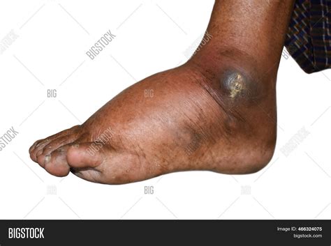 Pitting Edema Lower Image & Photo (Free Trial) | Bigstock