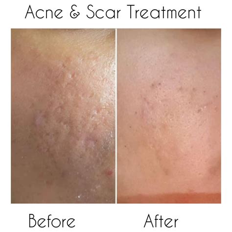 Derma Acne Scars