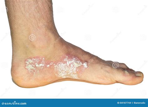 Plaque Psoriasis Bottom Of Feet at Mee Gorman blog