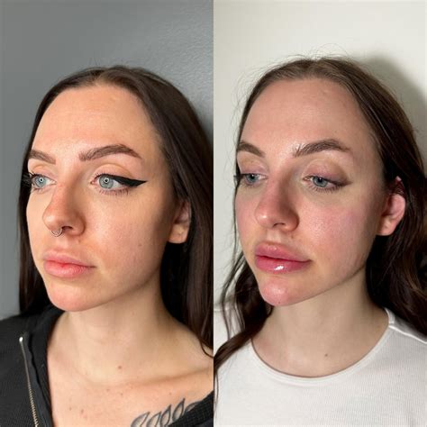 Dissolved the lips then refilled them, also did cheek and chin filler ...