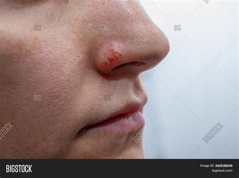 Fever Blister Inside Nose