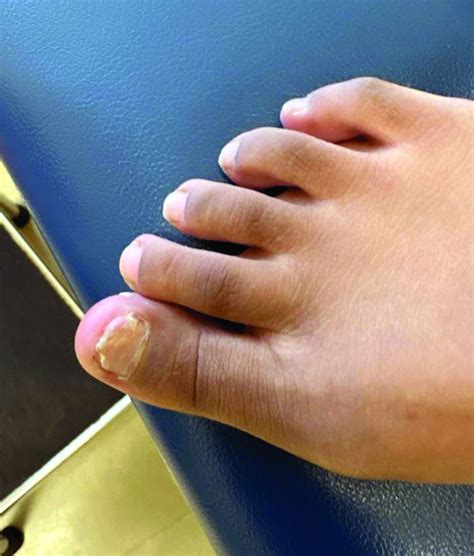 A 14-Year-Old Female Presents With a Growth Under Her Toenail | MDedge
