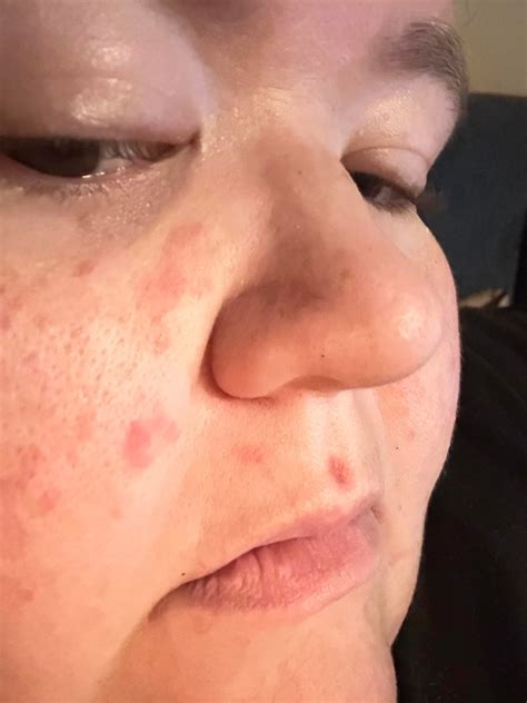 Rash appearing on cheeks and upper lip. Doesn’t itch or hurt. But peels and won’t go away. : r ...